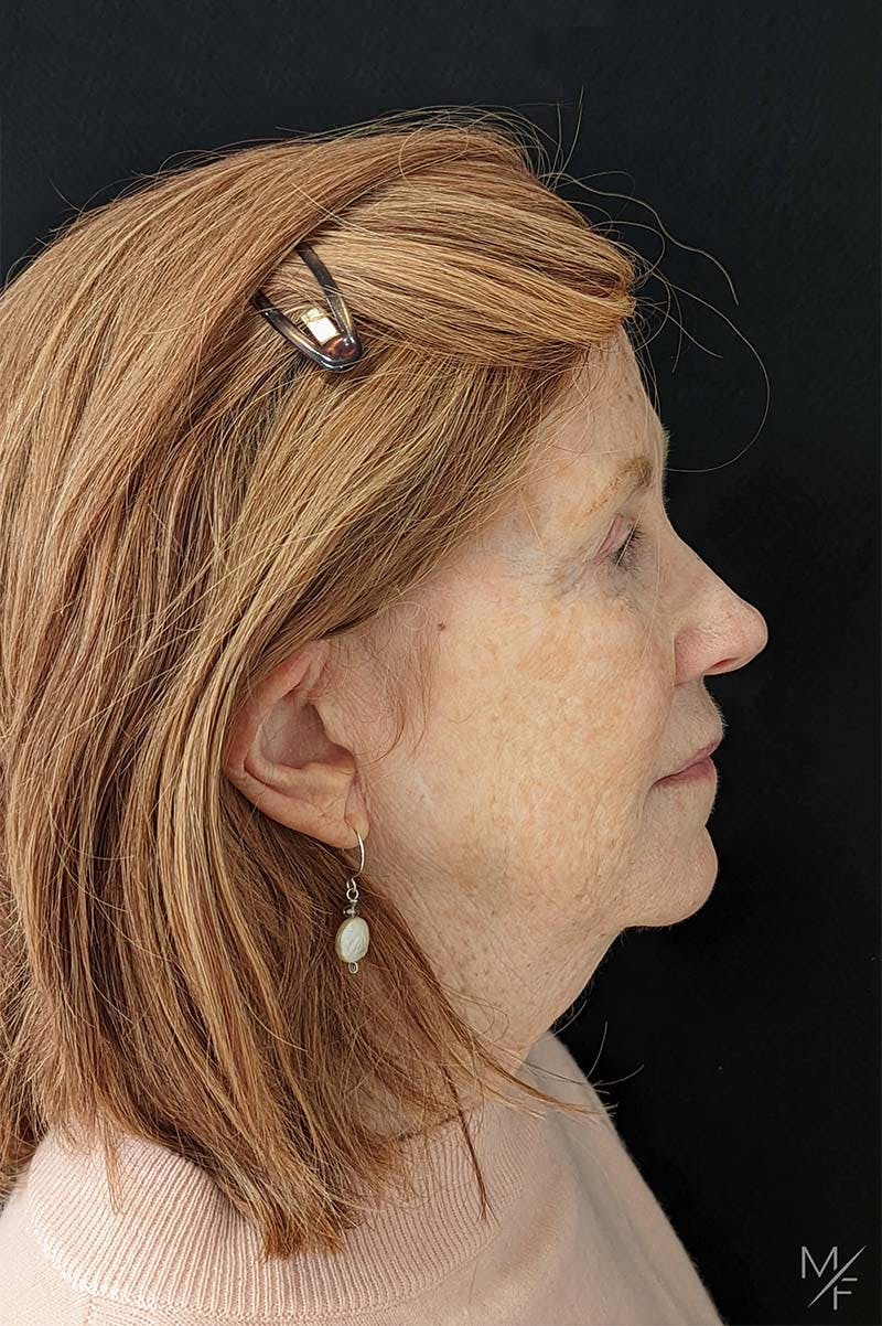Facelift Before & After Gallery - Patient 122032070 - Image 3