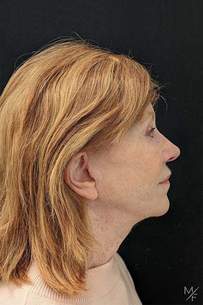 Neck Lift Before & After Gallery - Patient 367901 - Image 2
