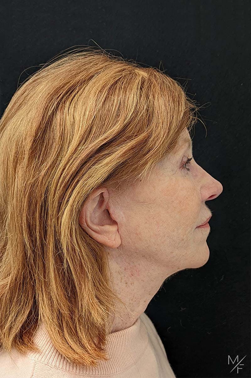 Facelift Before & After Gallery - Patient 122032070 - Image 4