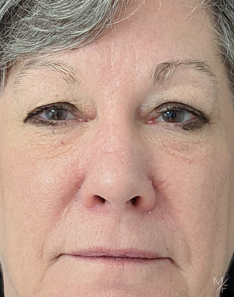Skin Cancer Reconstruction Before & After Gallery - Patient 122205978 - Image 2