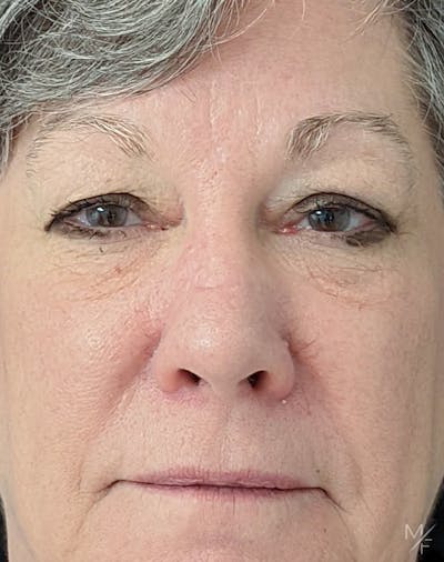 Skin Cancer Reconstruction Before & After Gallery - Patient 122205978 - Image 2
