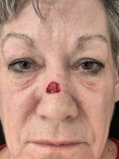 Skin Cancer Reconstruction Before & After Gallery - Patient 122205978 - Image 1