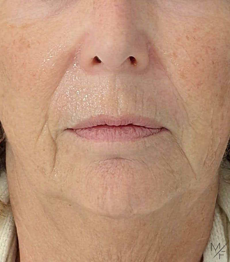 Dermal Fillers Before & After Gallery - Patient 122205989 - Image 1