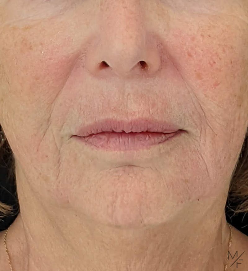Dermal Fillers Before & After Gallery - Patient 122205989 - Image 2
