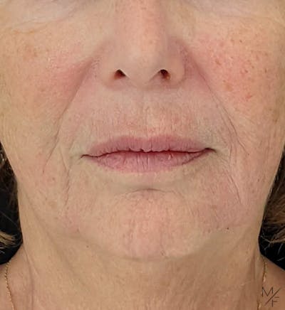 Dermal Fillers Before & After Gallery - Patient 122205989 - Image 2