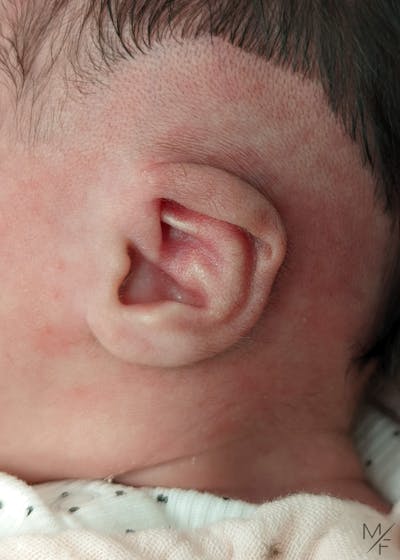 Ear Molding Before & After Gallery - Patient 122206067 - Image 1