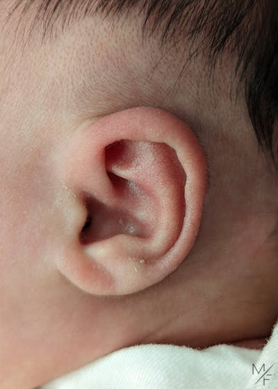 Ear Molding Before & After Gallery - Patient 122206067 - Image 2