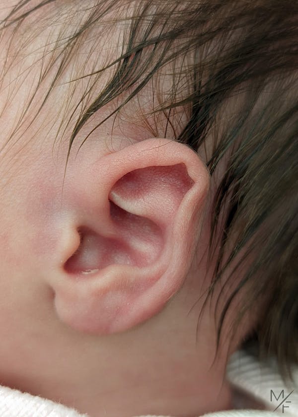 Ear Molding