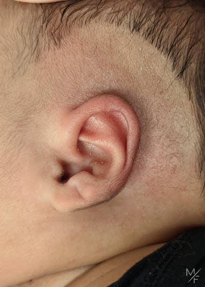 Ear Molding Before & After Gallery - Patient 122206065 - Image 2