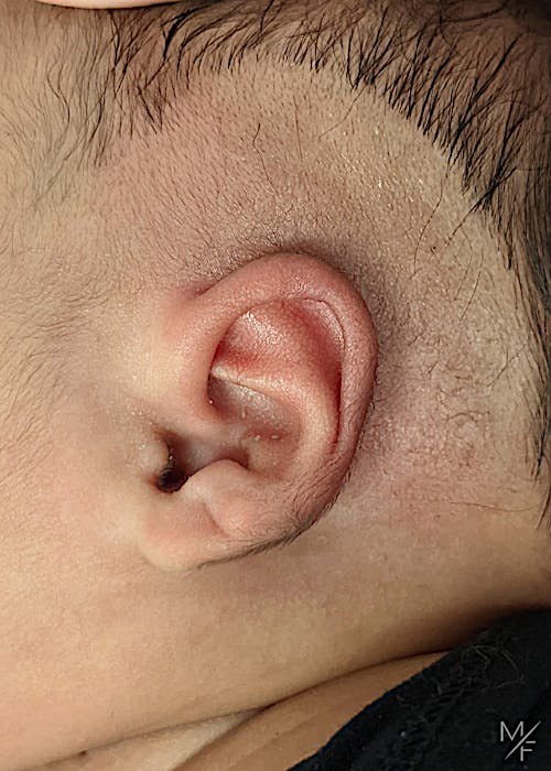 Ear Molding