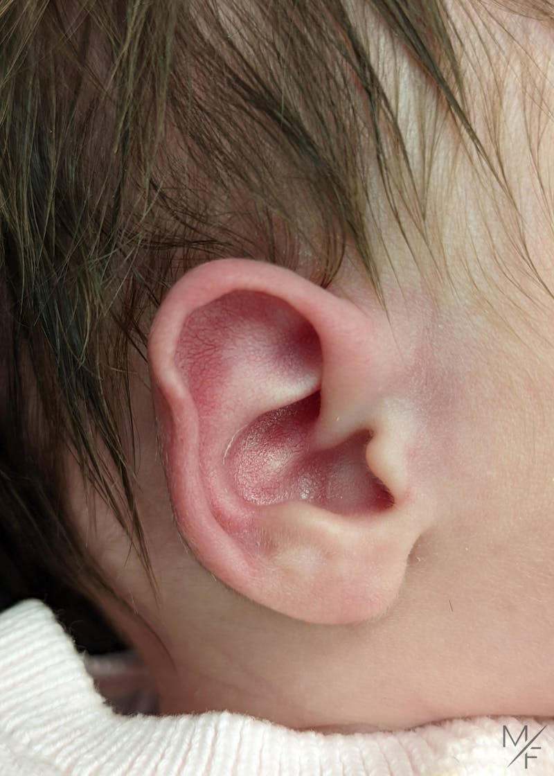 Ear Molding Before & After Gallery - Patient 122206066 - Image 3