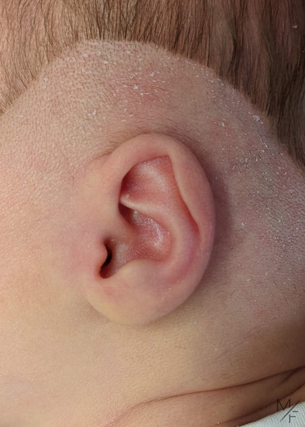 Ear Molding