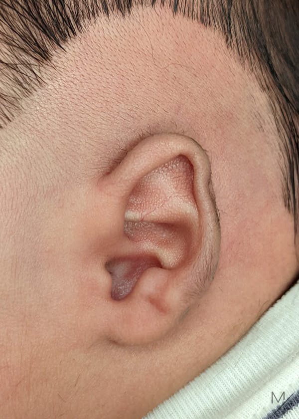 Ear Molding