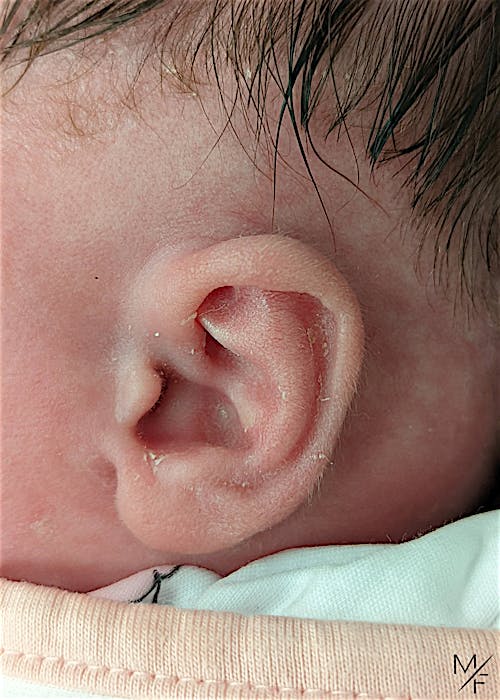 Ear Molding