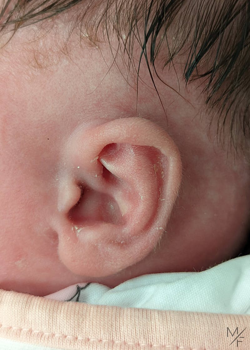 Ear Molding Before & After Gallery - Patient 122206066 - Image 2