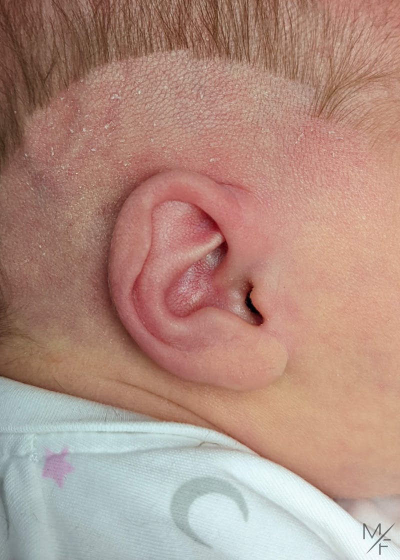 Ear Molding Before & After Gallery - Patient 122206064 - Image 3