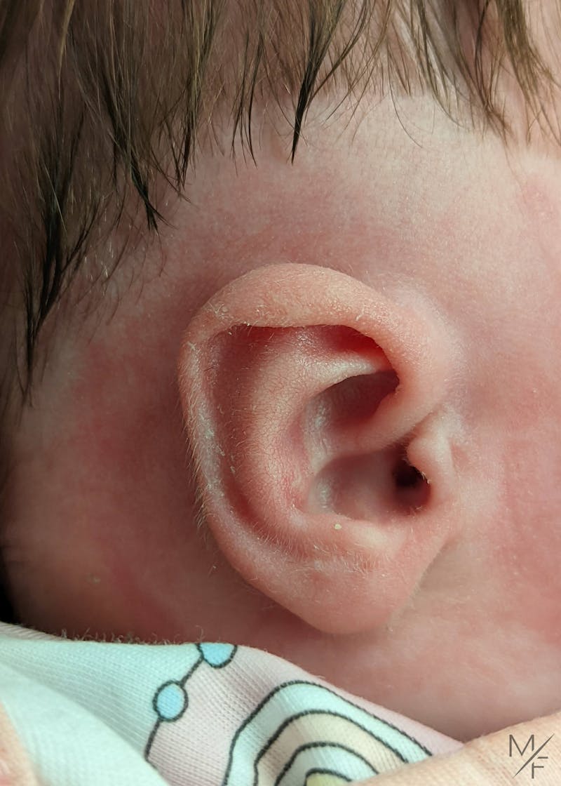 Ear Molding Before & After Gallery - Patient 122206066 - Image 4