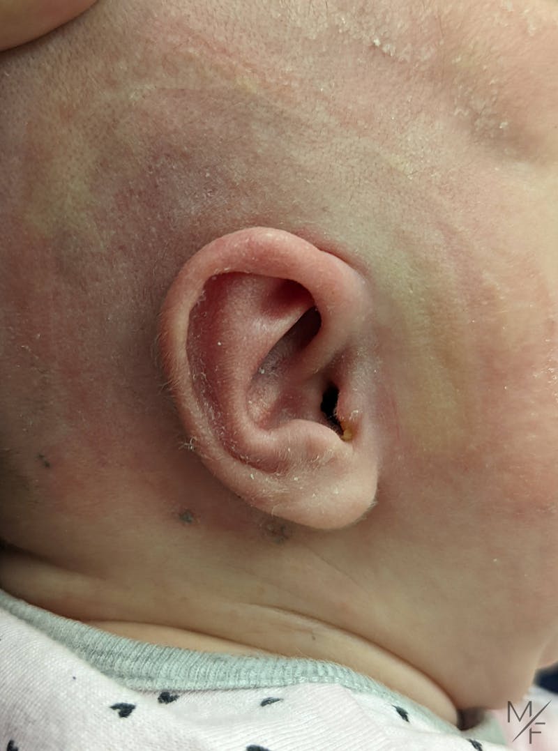 Ear Molding Before & After Gallery - Patient 122206064 - Image 4