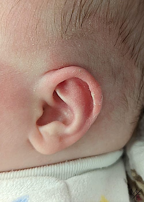 Ear Molding