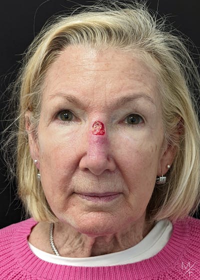 Skin Cancer Reconstruction Before & After Gallery - Patient 122974200 - Image 1