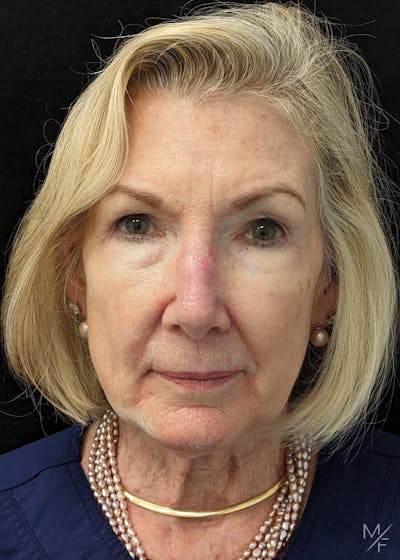 Skin Cancer Reconstruction Before & After Gallery - Patient 122974200 - Image 2