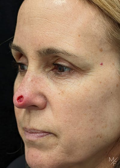 Skin Cancer Reconstruction Before & After Gallery - Patient 133112615 - Image 1