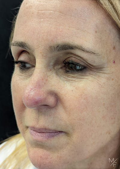 Skin Cancer Reconstruction Before & After Gallery - Patient 133112615 - Image 2