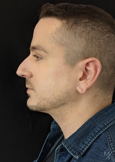 Rhinoplasty Before & After Gallery - Patient 133112931 - Image 1