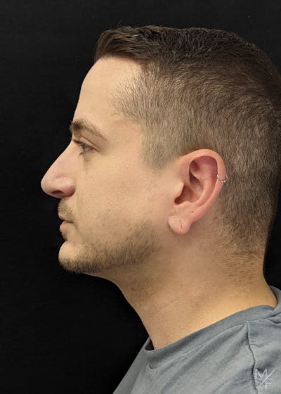 Rhinoplasty Before & After Gallery - Patient 133112931 - Image 2