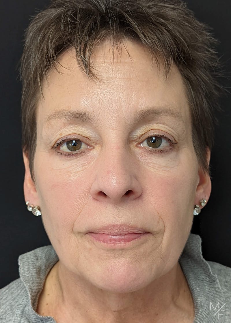 Blepharoplasty Before & After Gallery - Patient 133113416 - Image 1