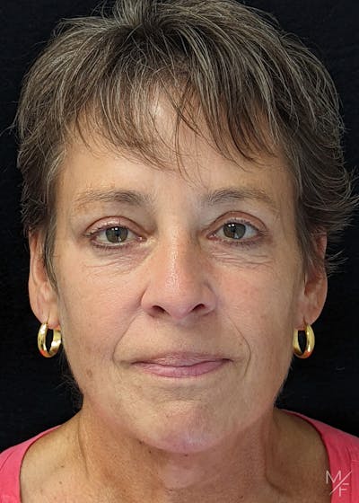 Blepharoplasty Before & After Gallery - Patient 133113416 - Image 2