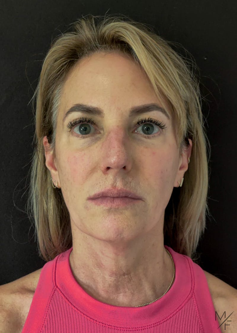 Facelift Before & After Gallery - Patient 121139445 - Image 1