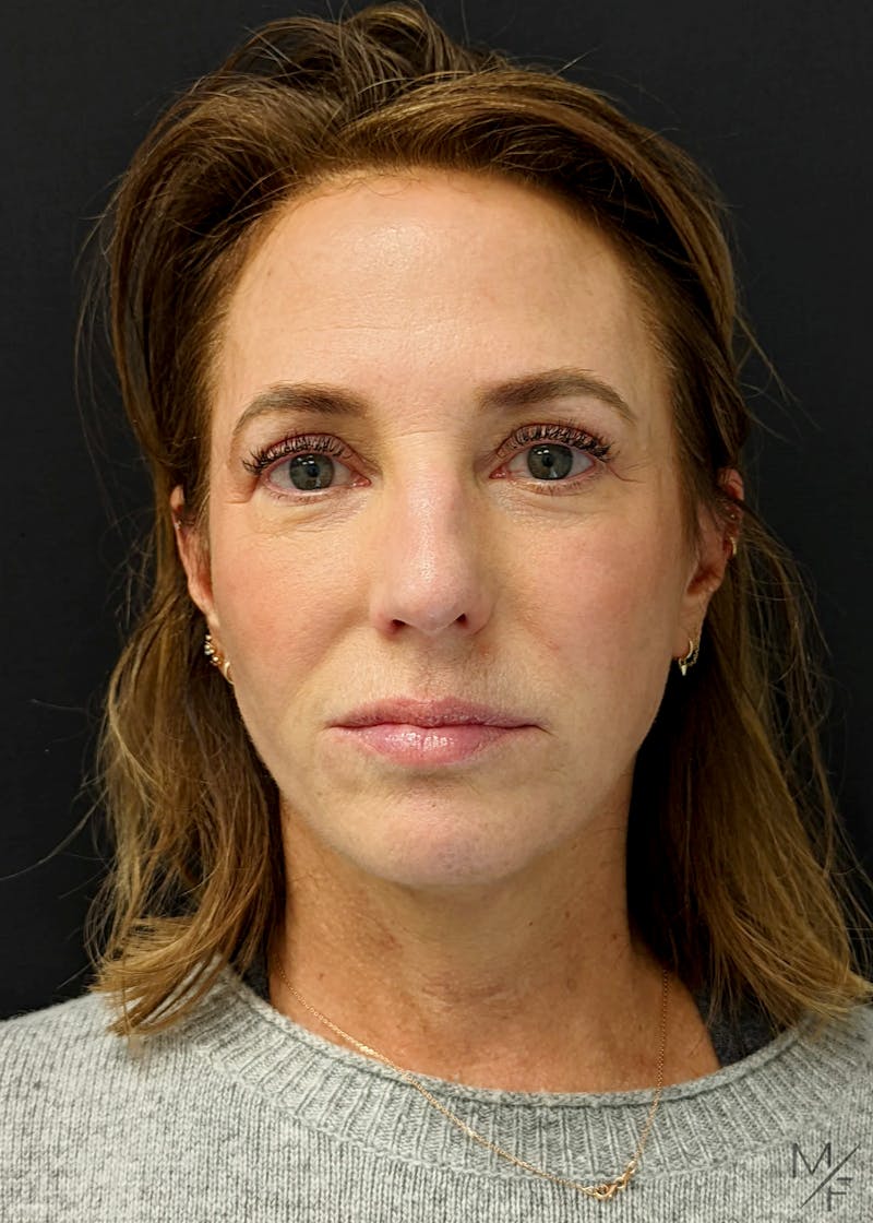 Neck Lift Before & After Gallery - Patient 371990 - Image 4