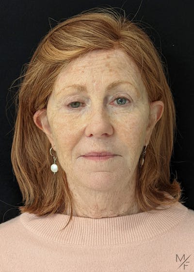 Facelift Before & After Gallery - Patient 122032070 - Image 1