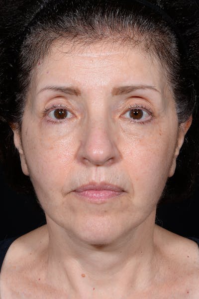 Blepharoplasty Before & After Gallery - Patient 141471946 - Image 2