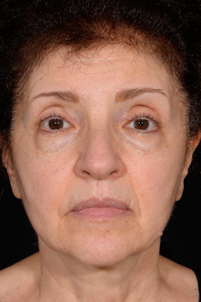 Blepharoplasty Before & After Gallery - Patient 141471946 - Image 1