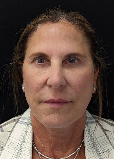 Dermal Fillers Before & After Gallery - Patient 141472095 - Image 1