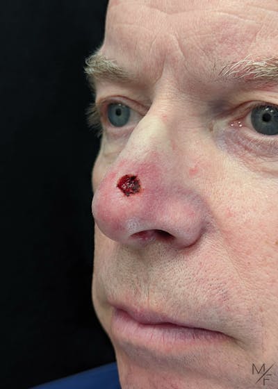 Skin Cancer Reconstruction Before & After Gallery - Patient 141472118 - Image 1