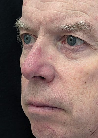 Skin Cancer Reconstruction Before & After Gallery - Patient 141472118 - Image 2