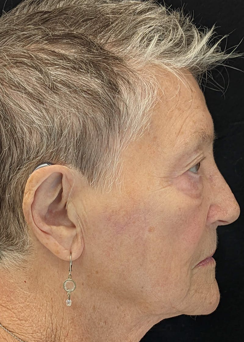Skin Cancer Reconstruction Before & After Gallery - Patient 141472119 - Image 2