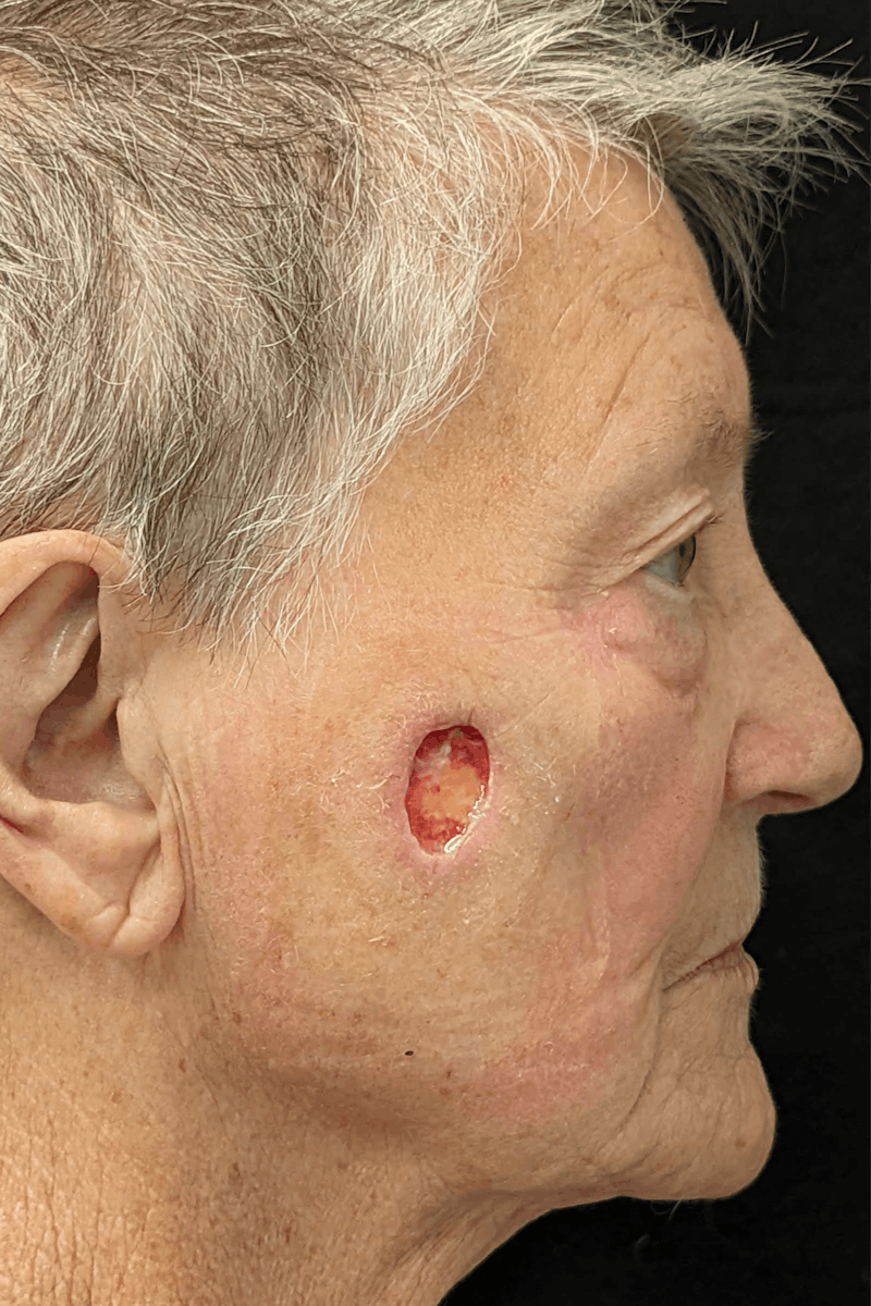 Skin Cancer Reconstruction Before & After Gallery - Patient 141472119 - Image 1