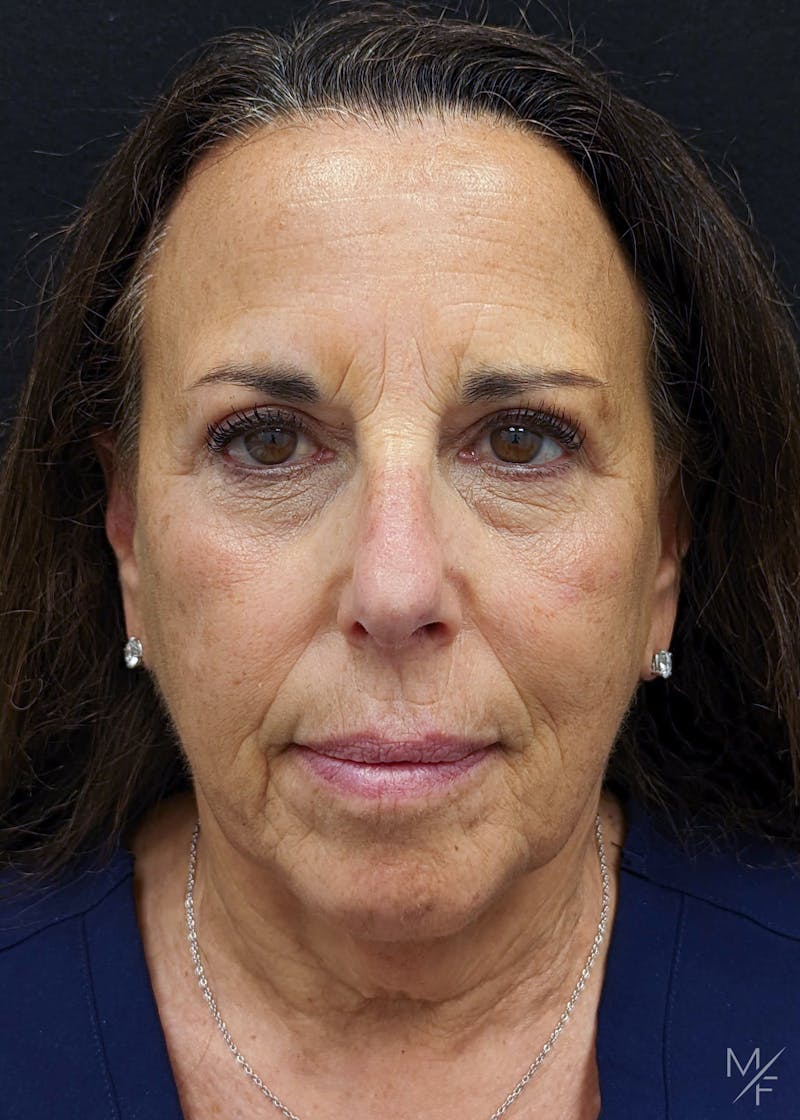 Blepharoplasty Before & After Gallery - Patient 141526077 - Image 2