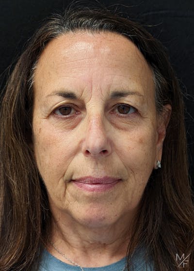 Blepharoplasty Before & After Gallery - Patient 141526077 - Image 1
