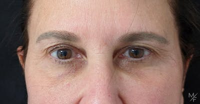 Blepharoplasty Before & After Gallery - Patient 141526078 - Image 1