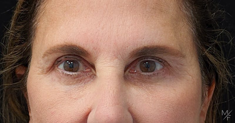 Blepharoplasty Before & After Gallery - Patient 141526078 - Image 2