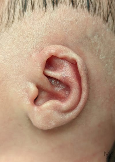 Ear Molding Before & After Gallery - Patient 141548375 - Image 1