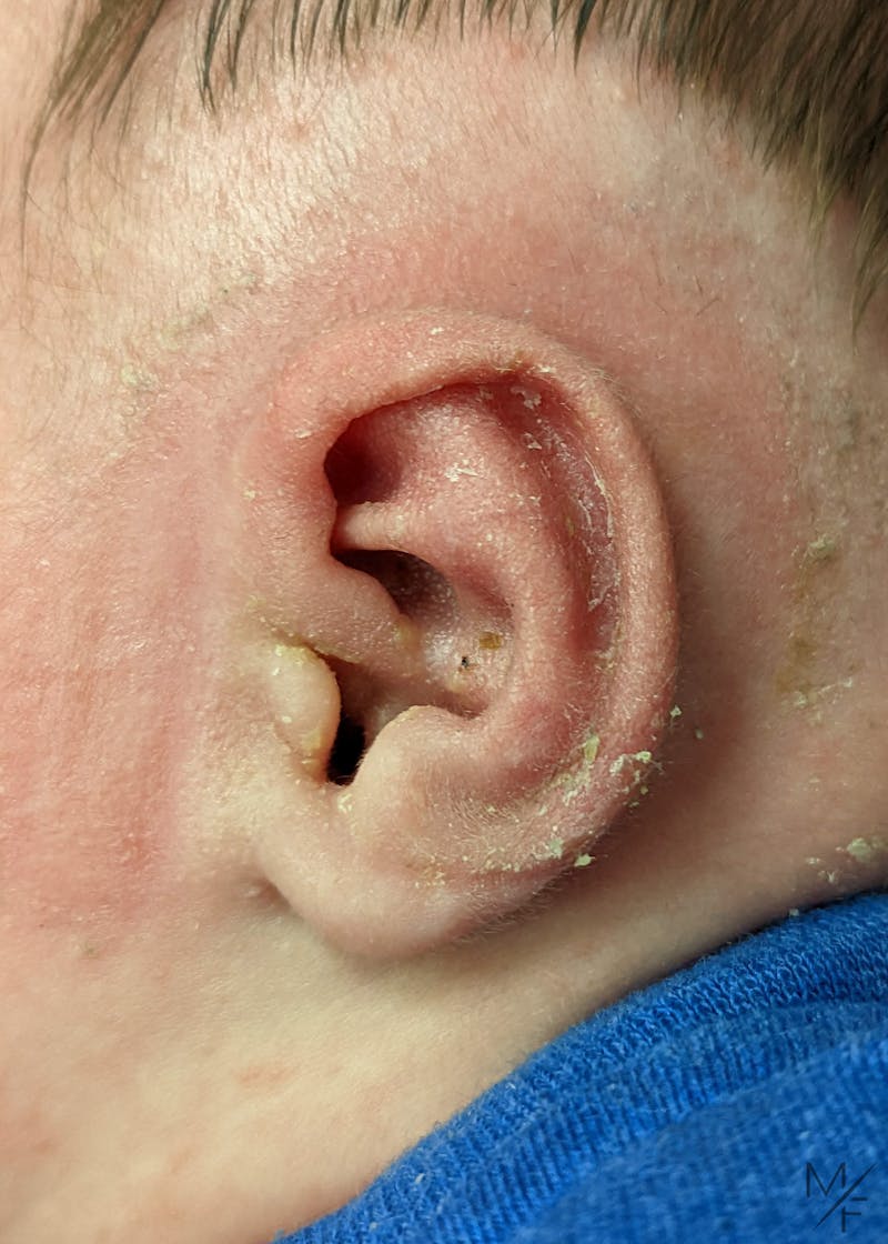 Ear Molding Before & After Gallery - Patient 141548375 - Image 2