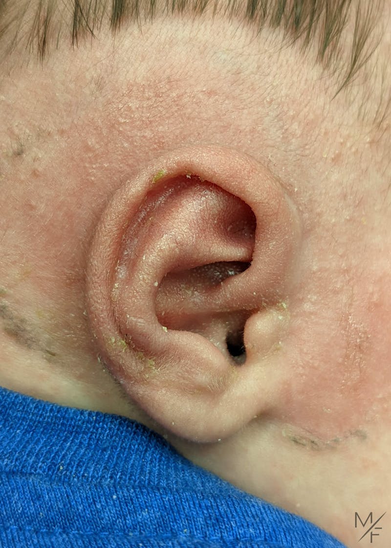 Ear Molding Before & After Gallery - Patient 141548376 - Image 2