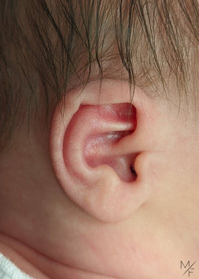 Ear Molding Before & After Gallery - Patient 141548376 - Image 1