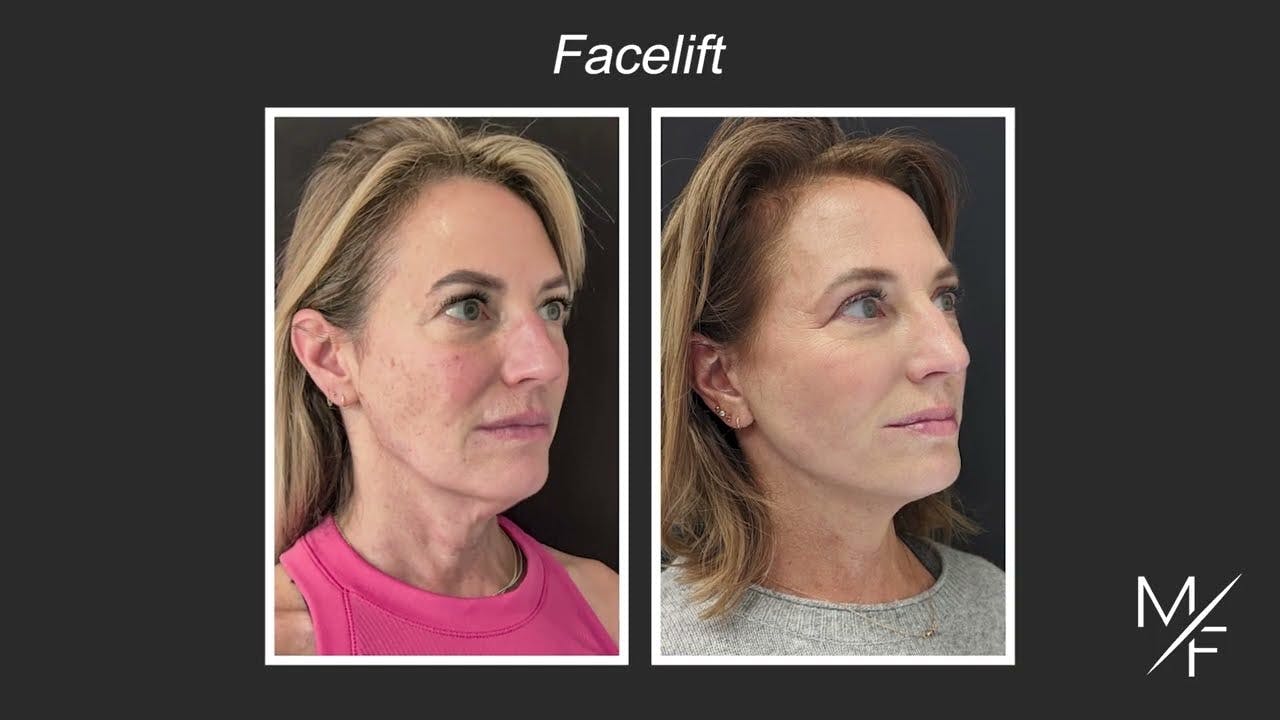 Before and after of a facelift